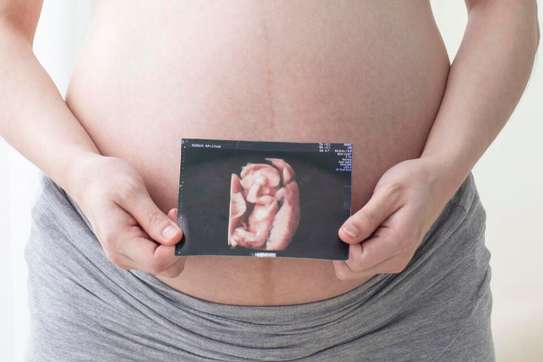 为什么怀孕16周的彩色多普勒超声预测性别会出现错误?图片