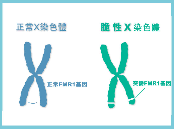 什么是脆性X综合症？图片